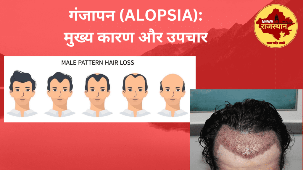 गंजापन (ALOPSIA): मुख्य कारण और उपचार