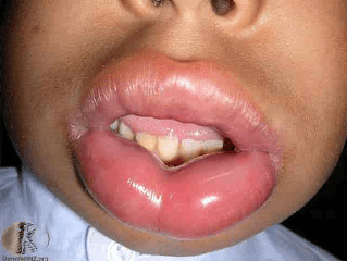 Angioedema