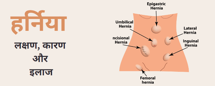 Hernia