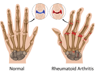 Rheumatoid Arthritis