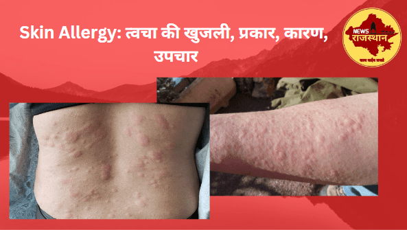 Skin Allergy: त्वचा की खुजली, प्रकार, कारण, उपचार