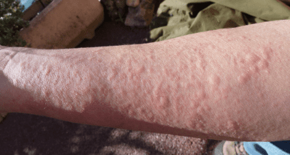 Skin Allergy