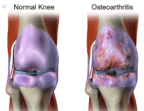 osteoarthritis