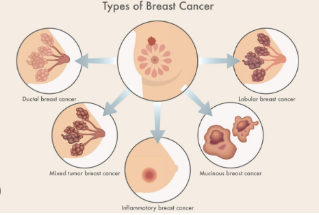 Breast Cancer