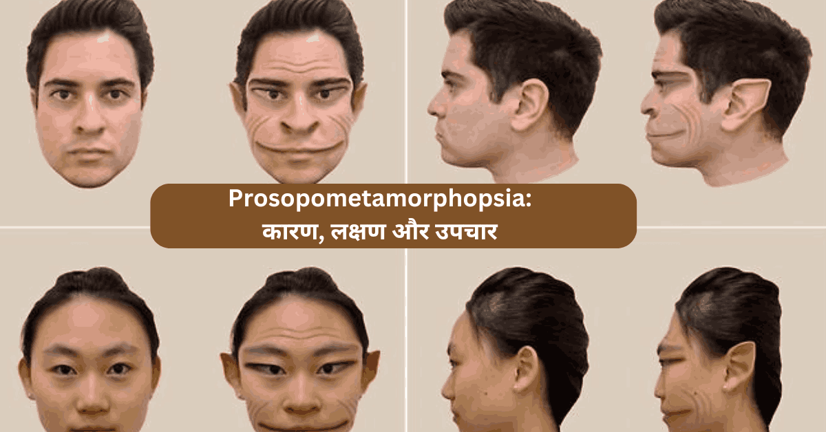 Prosopometamorphopsia कारण, लक्षण और उपचार